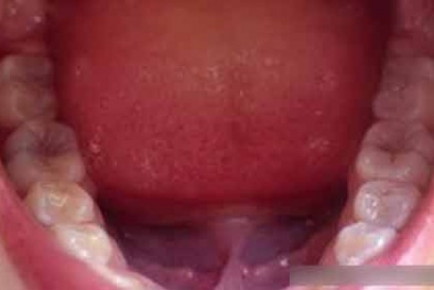 Ung thư ruột kết có thể xuất phát từ... miệng